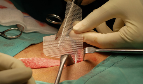 Understanding Hernia Repairs: A Comprehensive Guide to Surgical Options